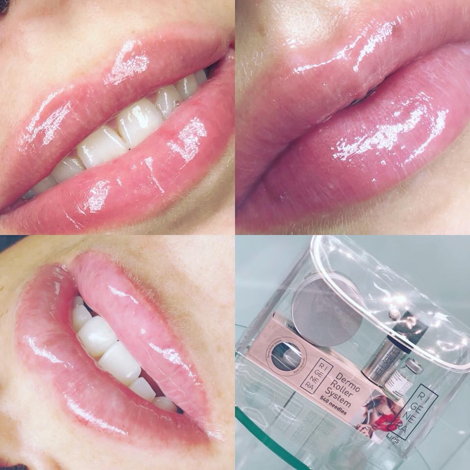 Trattamento Rimpolpante Labbra con Dermaroller