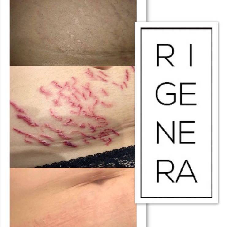 Needling Smagliature